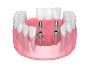 Types of Dental Implants