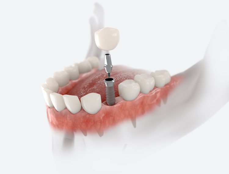 Dental implants have become an increasingly popular solution for replacing missing teeth. They offer an effective way to restore oral health. 